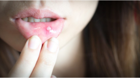 Afte e lesioni della bocca? Scopri i rimedi